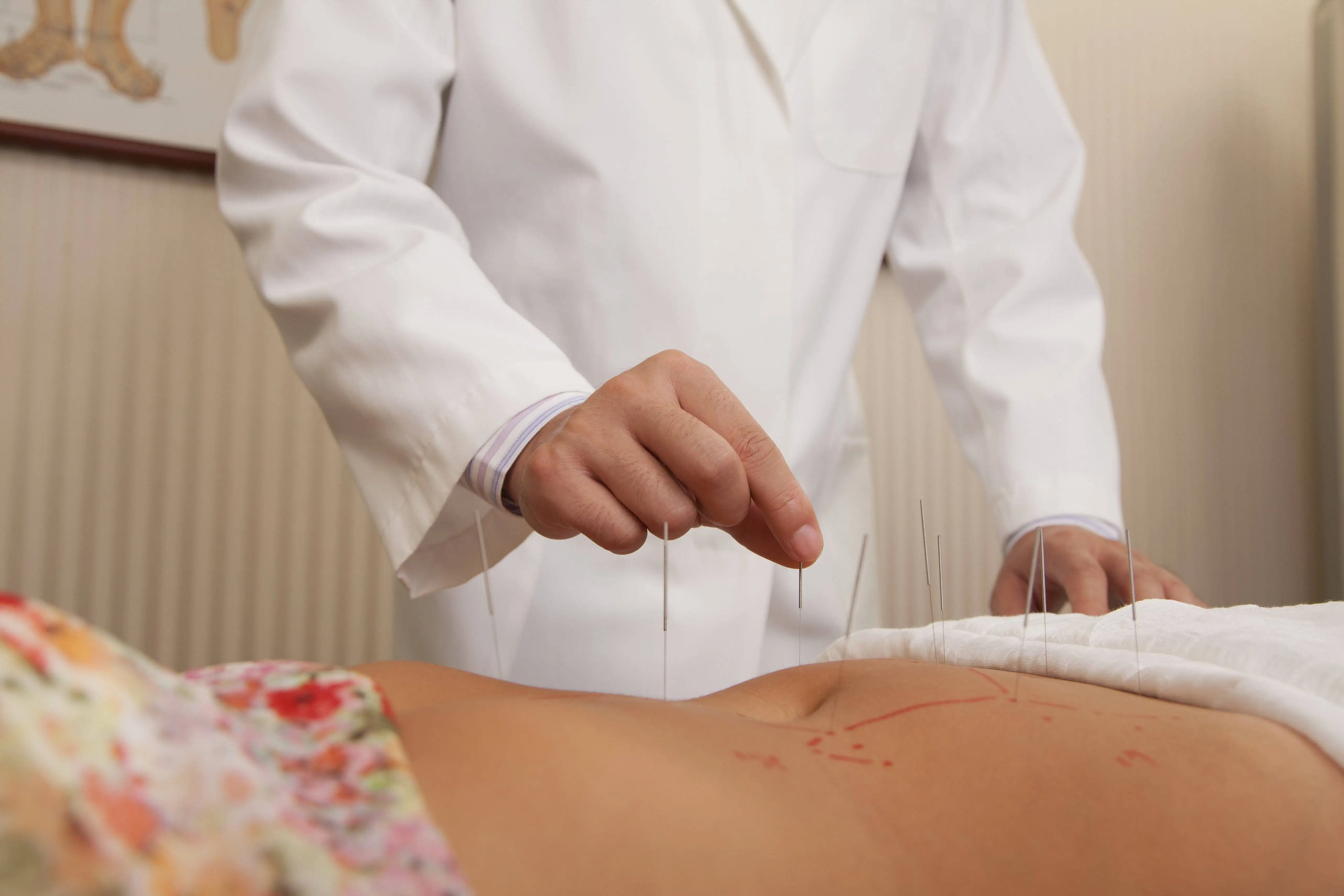 Acupuncture for Weight Loss